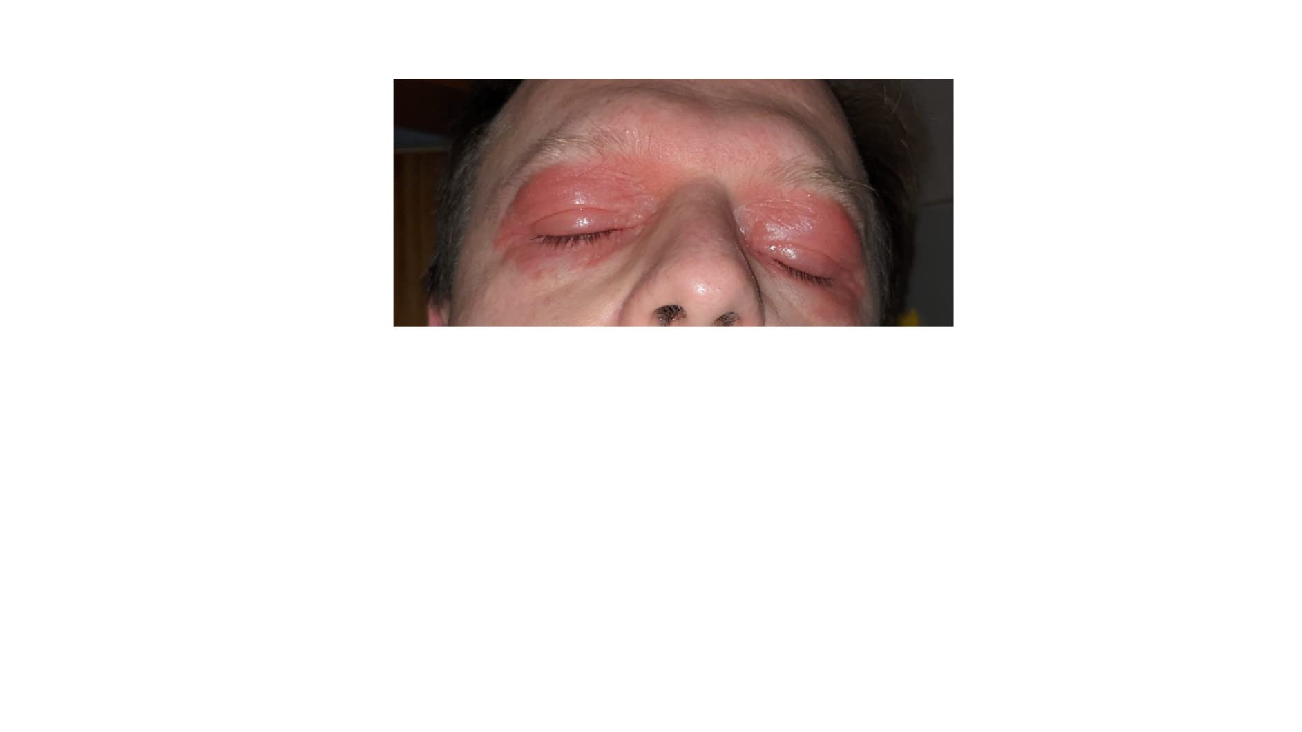 Sanft am Auge